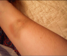 bruise Rebecca Partington 6 May 2004 CC BY SA 2.0